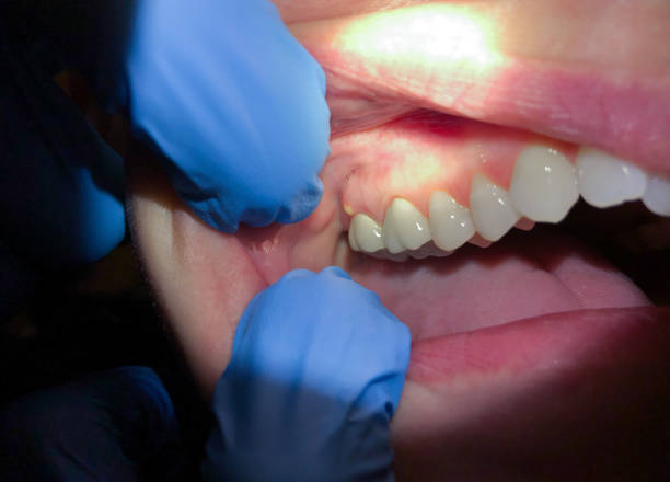 Best Emergency Tooth Extraction in Meadow Les, AK